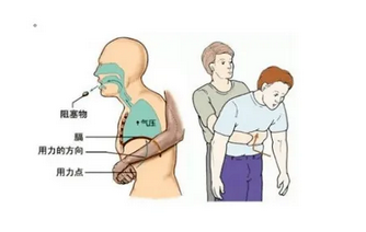遇到異物卡住喉嚨，可采取海姆立克急救法。海姆立克急救法是科學(xué)解除氣道異物堵塞的急救方法，分為成人版操作和兒童版操作兩種急救方法(圖1)